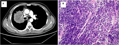 Case Report: Detection of Double ROS1 Translocations, SDC4-ROS1 and ROS1-GK, in a Lung Adenocarcinoma Patient and Response to Crizotinib